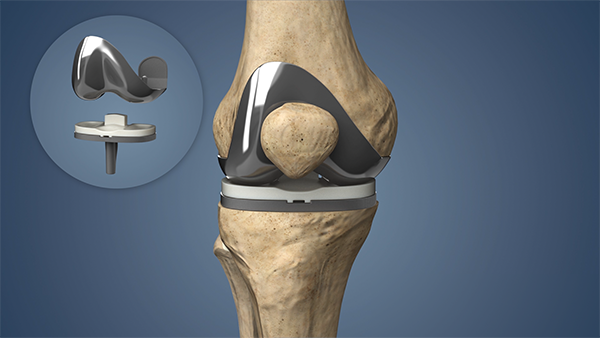 Protesis de Rodilla cirujano en monterrey