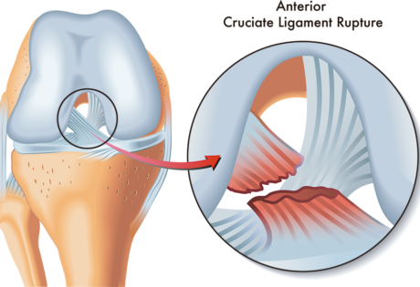 Reparacion de LCA rodilla cdmx